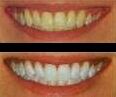 whiter teeth photo