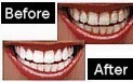 Whiter Teeth Images